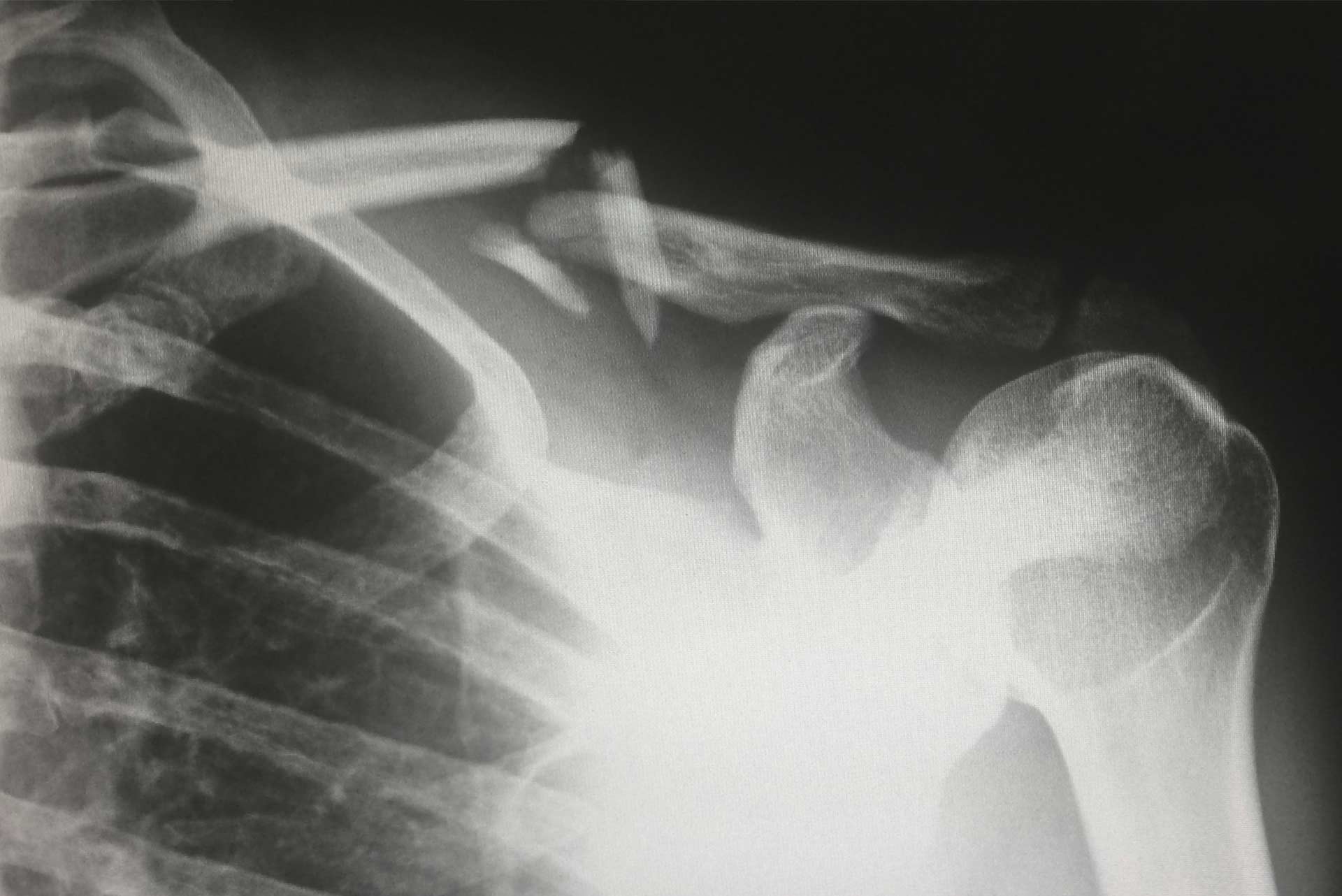 xray of broken collarbone, a source of acute pain.